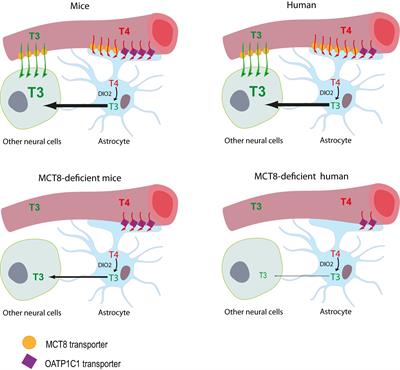 MCT8 Deficiency: The Road to Therapies for a Rare Disease